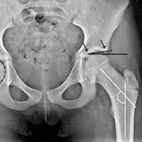 CT Hip Joint with Thigh